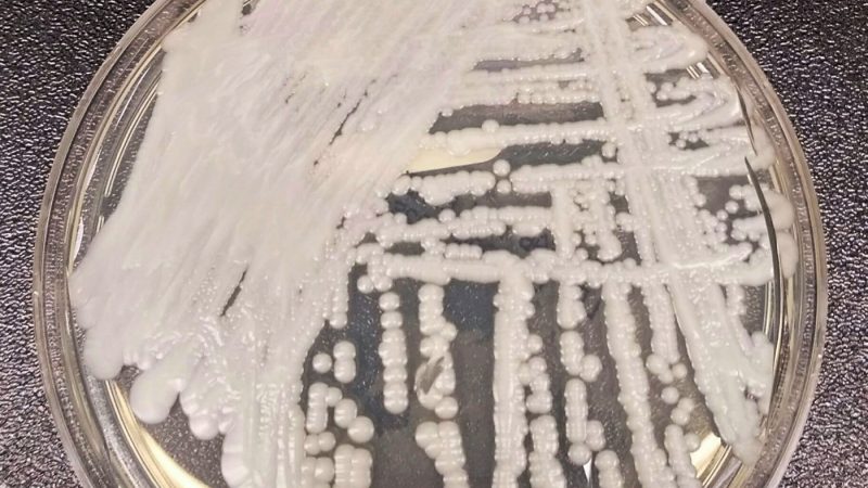 superbug-hits-27-states:-here’s-where-the-deadly-fungus-is-spreading