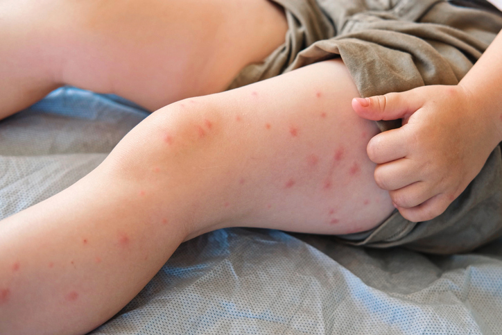 kids-sick-in-cuyahoga-county-measles-outbreak