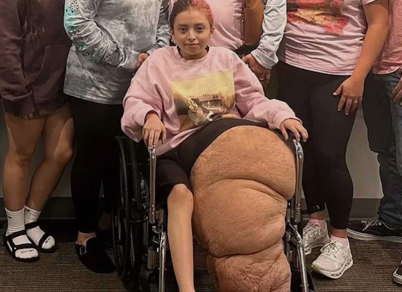 14-year-old-undergoes-surgery-to-remove-174-pound-leg-with-rare,-large-tumor