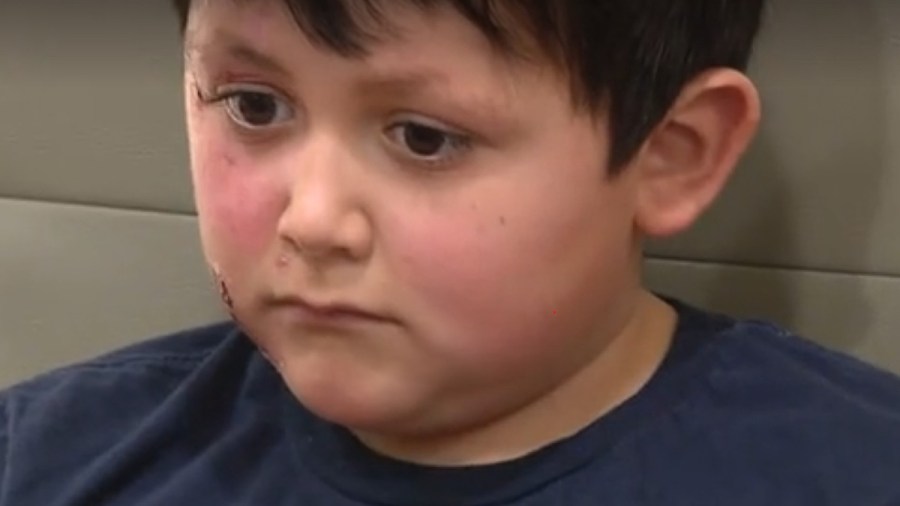 tiktok-trend-leaves-9-year-old-boy-with-severe-burns-from-microwaved-‘needoh’-toy