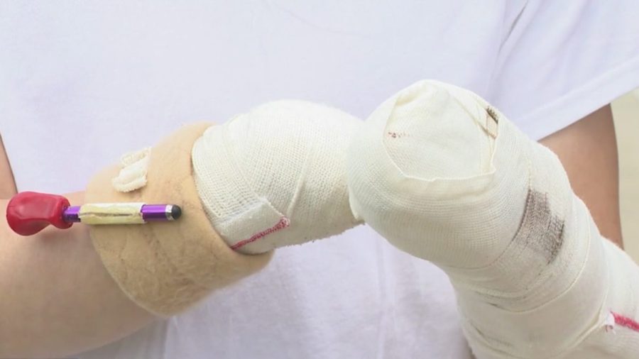 missouri-teen-loses-hand,-several-fingers-in-fireworks-accident