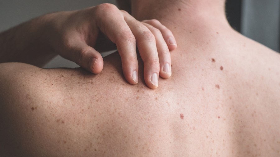 how-to-spot-and-prevent-the-deadliest-form-of-skin-cancer