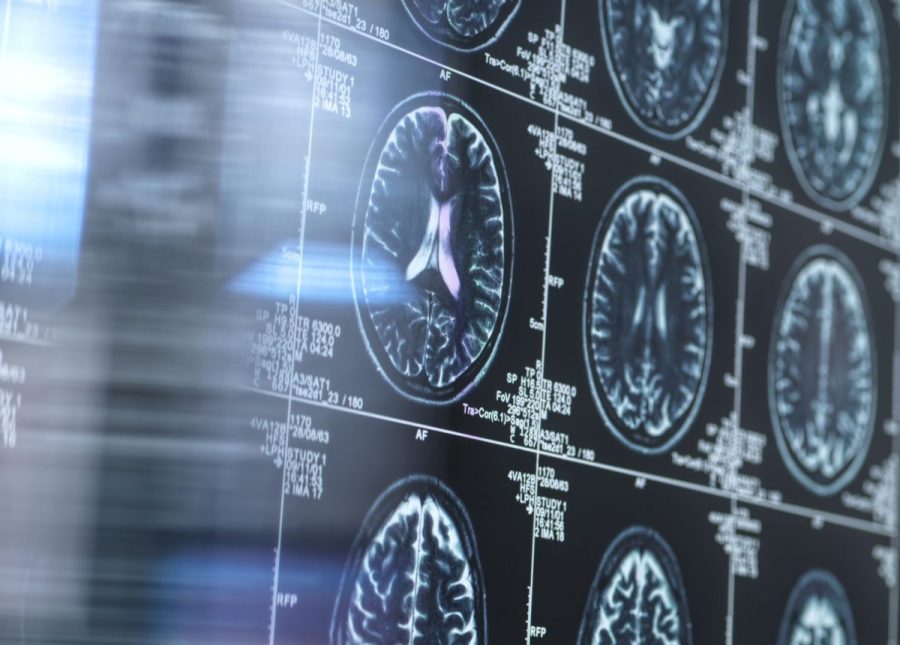 alzheimer’s-study-finds-link-between-breakfast-staple-and-reduced-risk-of-disease