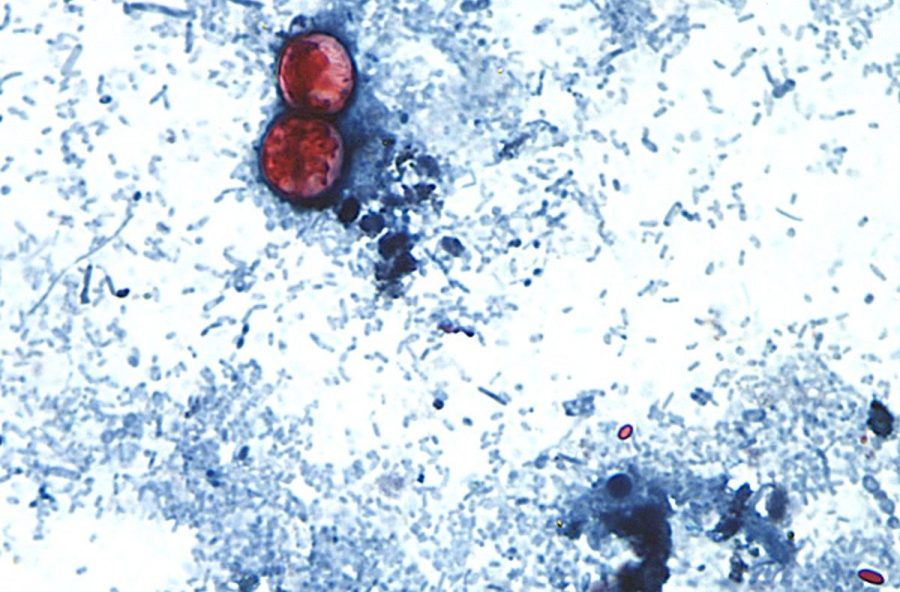 why-cyclospora-can-be-deadly-for-some-people