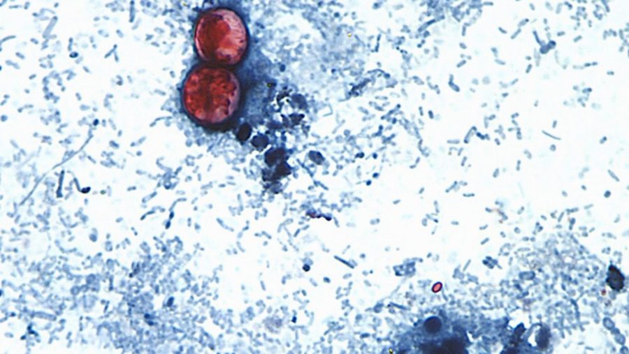 over-20k-cyclosporiasis-cases-suspected-in-us-as-outbreak-reportedly-linked-to-6-more-states