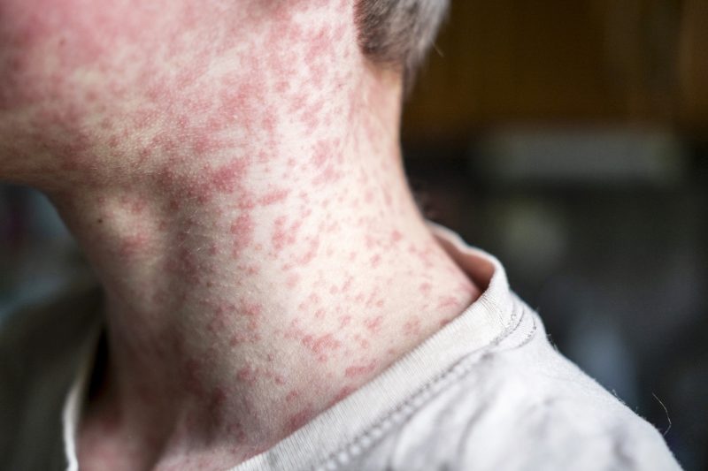 suspected-measles-exposure-at-university-hospitals-rainbow-babies-&-children’s-hospital