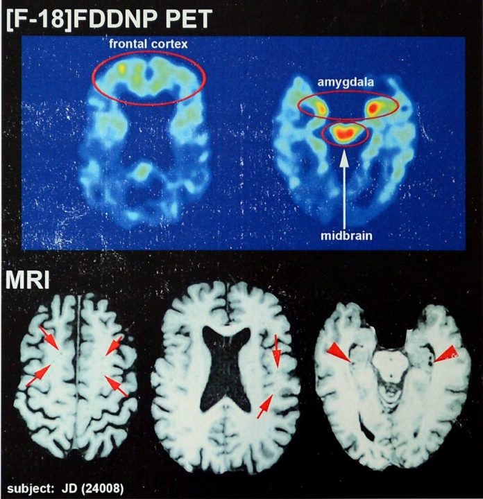 at-least-1-in-4-former-nfl-players-has-cte:-study