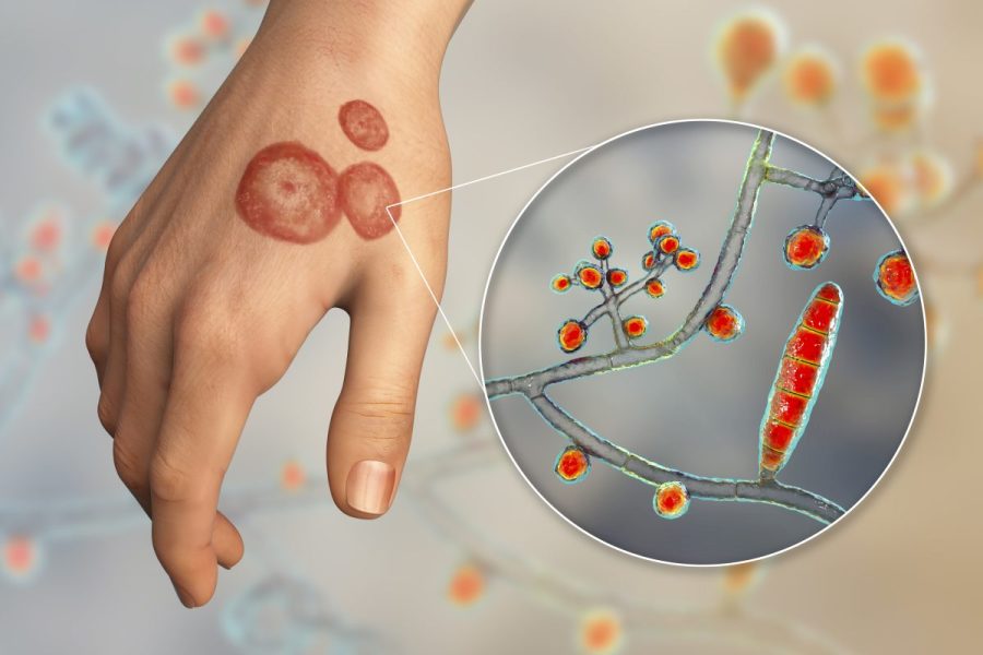 drug-resistant-ringworm-fungus-has-spread-to-29-countries:-study