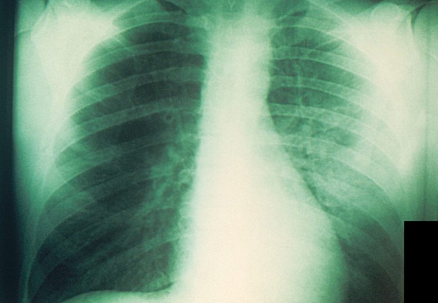 pneumonic-plague:-what-is-it-and-how-dangerous-can-it-be?